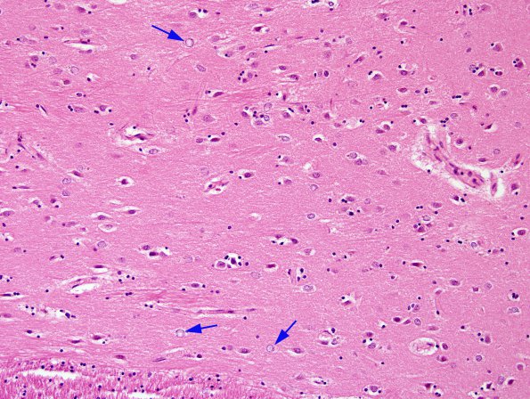 1A1 Astrocyte, Alzheimer type II (Case 1) BG H&E 1