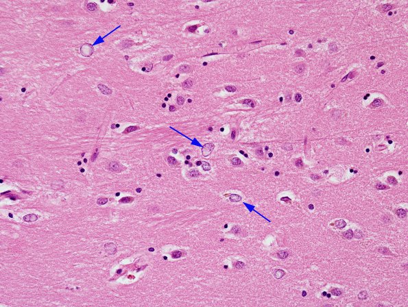 1A2 Astrocyte, Alzheimer type II (Case 1) BG H&E 2