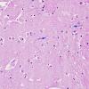 2 Astrocyte, Alzheimer type II (Case 2) BG H&E 2