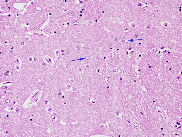 2 Astrocyte, Alzheimer type II (Case 2) BG H&E 2