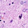 3 Astrocyte, Alzheimer type II (Case 4) BG H&E 2