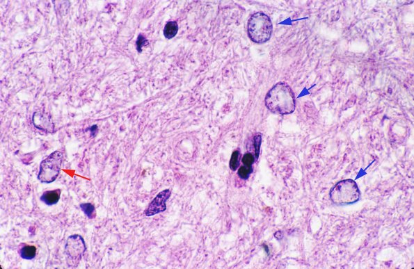 3 Astrocyte, Alzheimer type II (Case 4) BG H&E 2