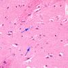4 Astrocytes, Alzheimer type II (Case 5) H&E 40X