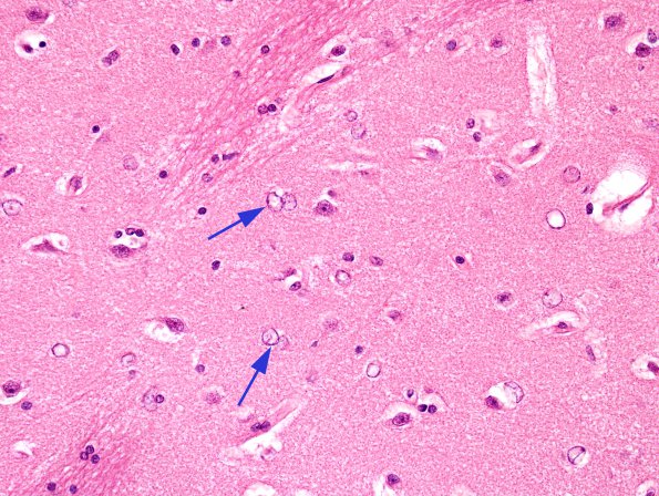 4 Astrocytes, Alzheimer type II (Case 5) H&E 40X