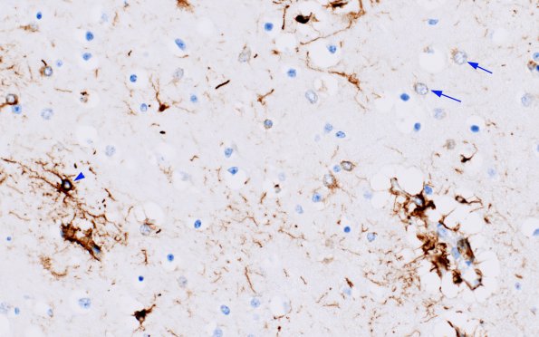 5A1 Astrocytes, Alzheimer type II (Case 6) GFAP 1