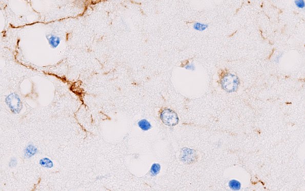 5A2 Astrocytes, Alzheimer type II (Case 6) GFAP 1