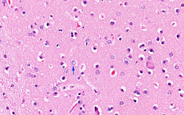 7A1 Astrocytes, Alzheimer type 2 (Case 7) N2 40X copy