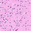7A2 Astrocytes, Alzheimer type 2 (Case 7) N1 40X