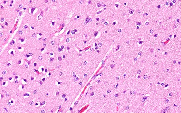 7A2 Astrocytes, Alzheimer type 2 (Case 7) N1 40X