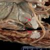 1A Arachnoid  Fibrohyaline plaques (Case 1) 1