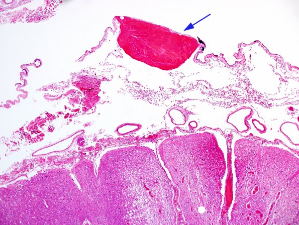 1B1 Arachnoid Fibrohyaline plaque (Case 1) H&E 1