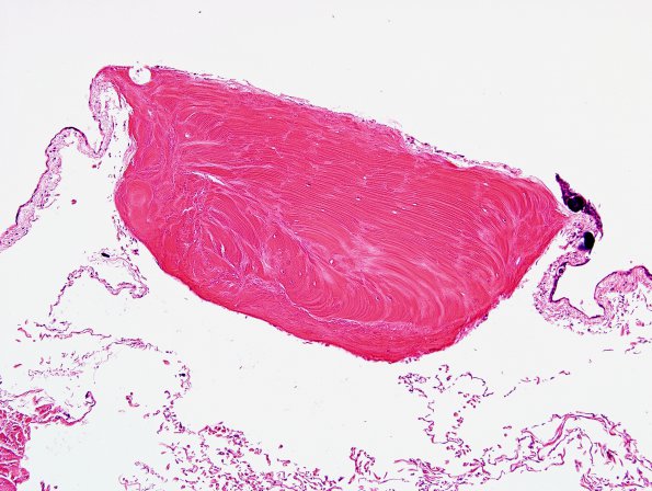 1B2 Arachnoid Fibrohyaline plaque (Case 1) H&E 2