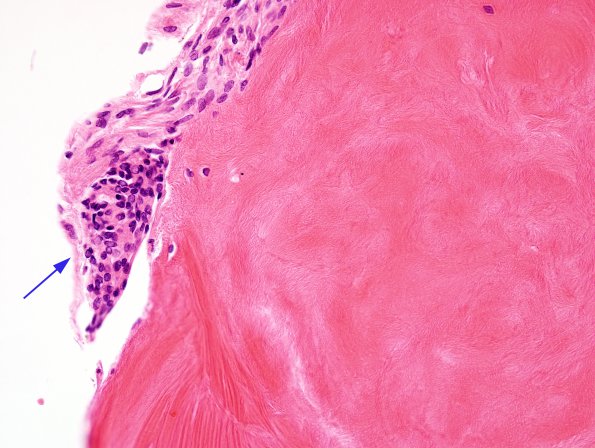 1B3 Arachnoid Fibrohyaline plaque (Case 1) H&E 