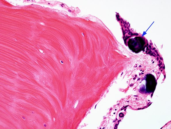 1B4 Arachnoid Fibrohyaline plaque (Case 1) H&E 4