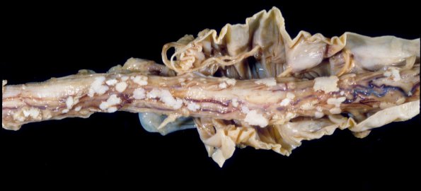 3 Arachnoid  Fibrohyaline 1 plaques (Case 3) 1