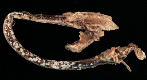 5A1 Arachnoid Fibrohyaline plaque in Meningitis (Case 5) Gross_8