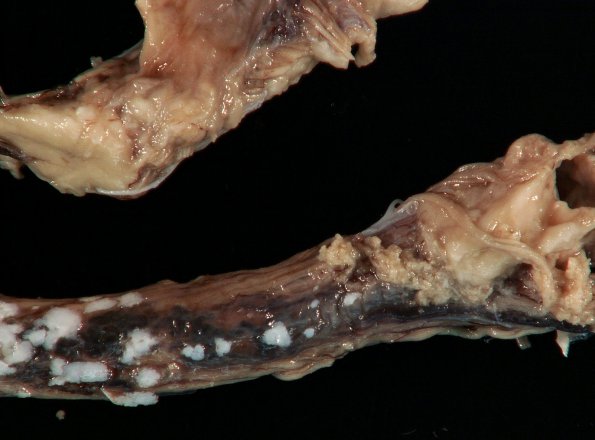 5A2 Arachnoid Fibrohyaline plaque in Meningitis (Case 5)