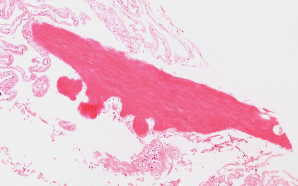 6A1 Fibrovascular hyaline plaques (Case 6) N12 H&E 2A