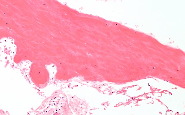 6A2 Fibrovascular hyaline plaques (Case 6) N12 H&E 1a