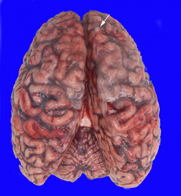 7A1 (Case 7) Fibrohyalin bone