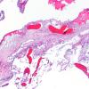 7A2 (Case 7) Fibrohyalin bone H&E 2X