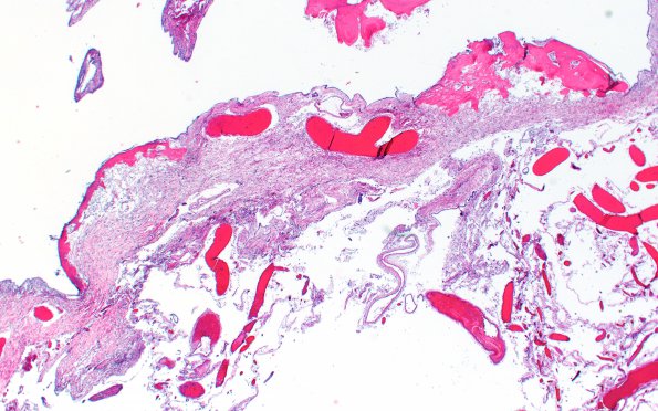 7A2 (Case 7) Fibrohyalin bone H&E 2X