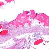 7A3 (Case 7) Fibrohyalin bone H&E 4X 2