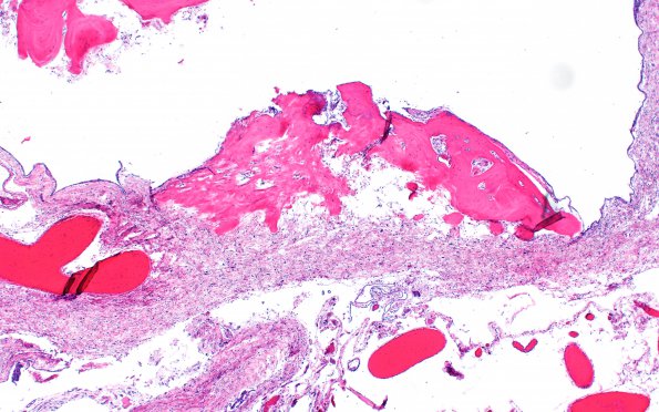 7A3 (Case 7) Fibrohyalin bone H&E 4X 2