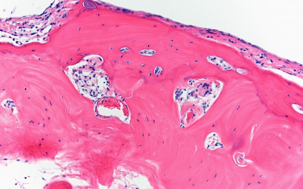 7A4 (Case 7) Fibrohyaline bone N13 H&E 20X A