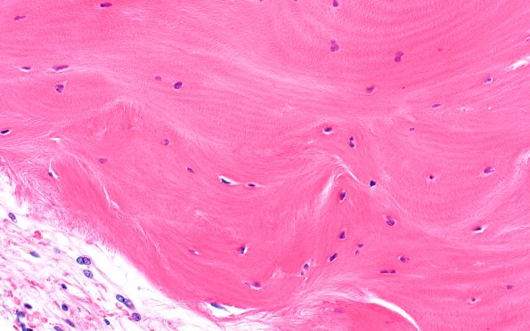 7A5 (Case 7) Fibrohyalin bone H&E N13 40X 2