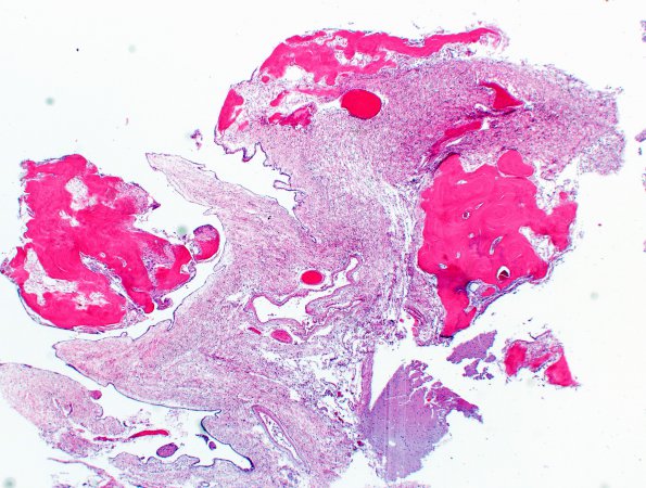 7A6 (Case 7) Fibrohyalin bone N13 H&E 2X