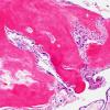 7A7 (Case 7) Fibrohyalin bone H&E 10X 2