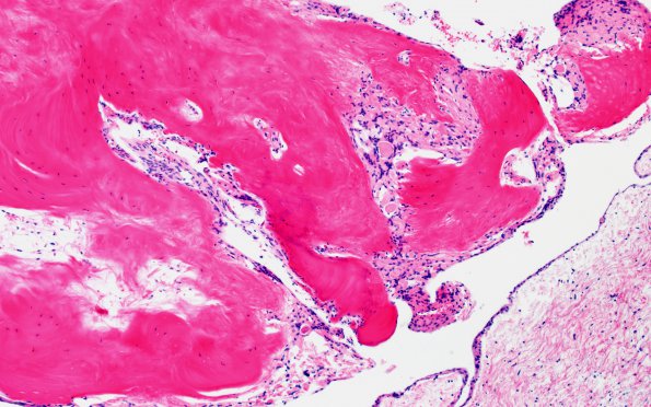 7A7 (Case 7) Fibrohyalin bone H&E 10X 2