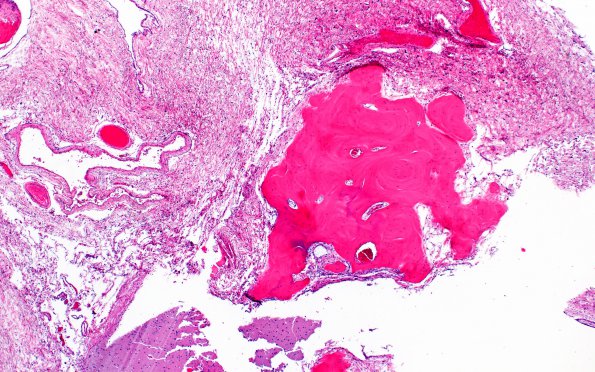 7A8 (Case 7) Fibrohyalin bone H&E 10X 3