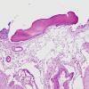 8A2 Fibrohyaline plaque leptomeningeal ossification (Case 8) H&E 1