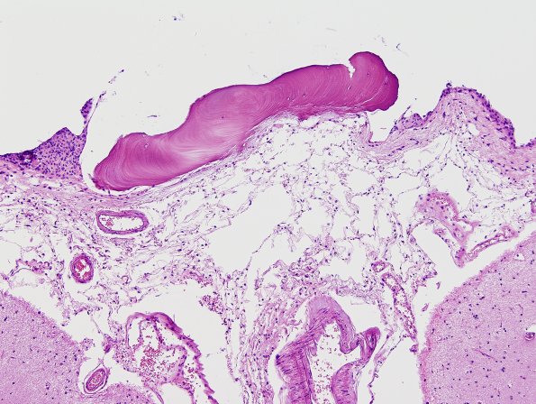 8A2 Fibrohyaline plaque leptomeningeal ossification (Case 8) H&E 1