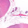 9A1 Fibrohyaline plaque (Case 9) N11 H&E 2X copy