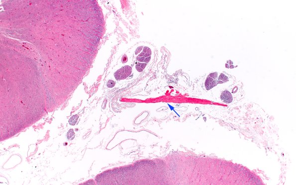9A1 Fibrohyaline plaque (Case 9) N11 H&E 2X copy