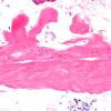 9A2 Fibrohyaline plaque (Case 9) N11 H&E 20X A