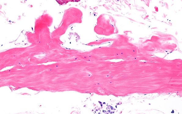 9A2 Fibrohyaline plaque (Case 9) N11 H&E 20X A