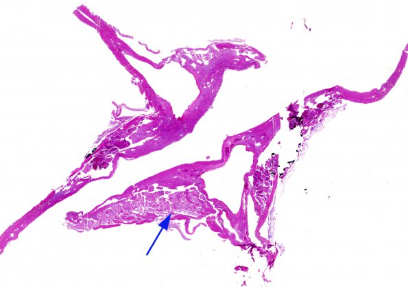 10A1 Dura, arachnoid granulations, fibrosis (Case 10) H&E