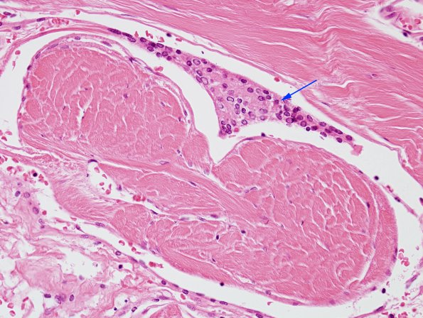 10A3 Arachnoid granulations, perisaggital (Case 10) H&E 1 copy