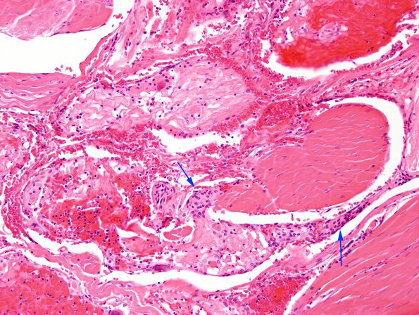 10A4 Arachnoid granulations, perisaggital (Case 10) H&E 4 copy