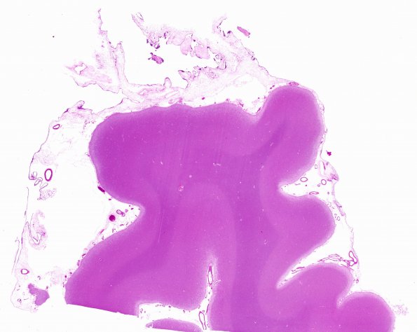 11A1 Arachnoid Granulations (Case 11) H&E 2