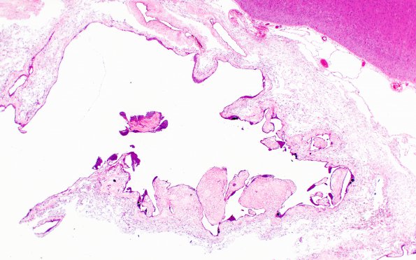 11A2 Arachnoid Granulations (Case 11) H&E 5