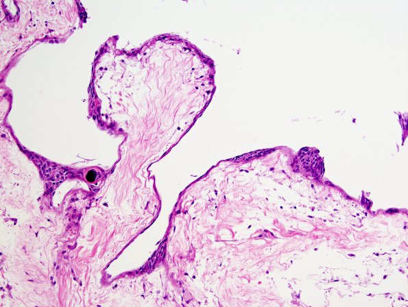 11A3 Arachnoid Granulations (Case 11) H&E 4