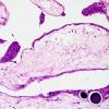 11A4 Arachnoid Granulations (Case 11) H&E 5