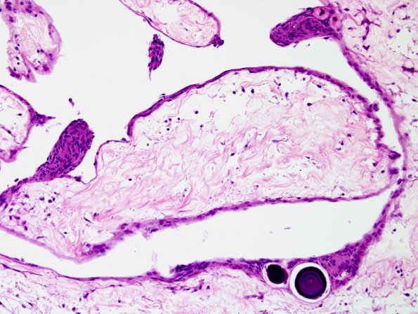 11A4 Arachnoid Granulations (Case 11) H&E 5