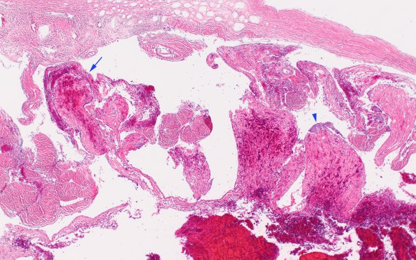 12A1 MVA (Case 12) N15 Arachnoid granulations 4X copy