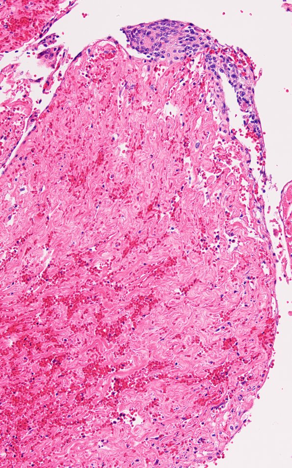 12A2 MVA (Case 12) N15 Arachnoid granulations 20X 2